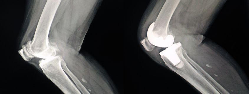 Knee Joint Replacement Before and After